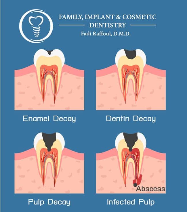 etapas absceso dental