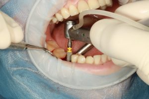Dentadura fija sobre 4 implantes precio, ventajas y todo lo que debes saber